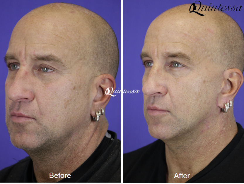 Mini Facelift Before and After Photos in , , Patient 19871