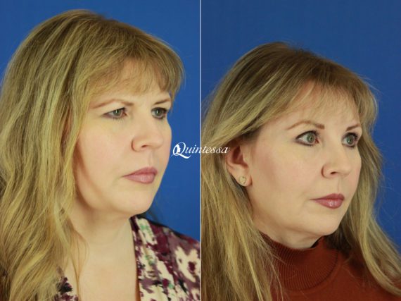 Brow Lift Before and After Photos in , , Patient 19875