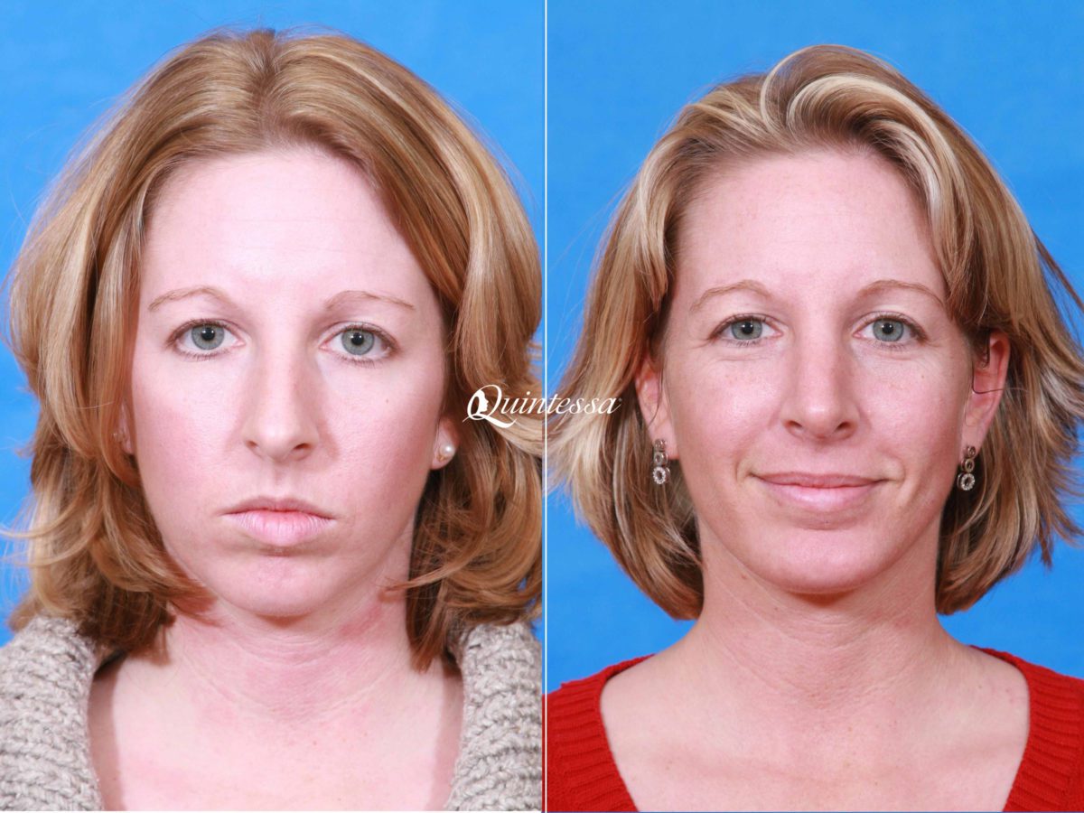 Chin Augmentation Before and After Photos in , , Patient 19890