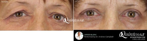 Eyelid Surgery Before and After Photos in , , Patient 19894