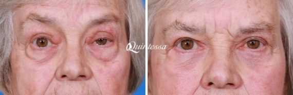 Eyelid Surgery Before and After Photos in , , Patient 19899