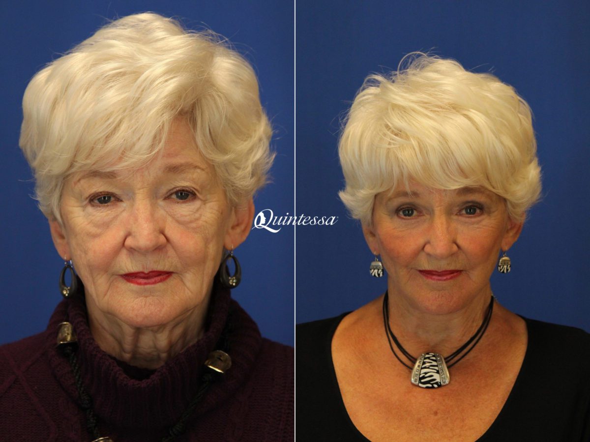 Facelift Before and After Photos in , , Patient 19909