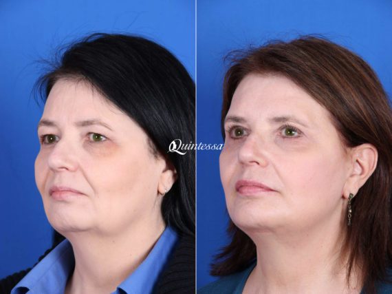 Facelift Before and After Photos in , , Patient 19914