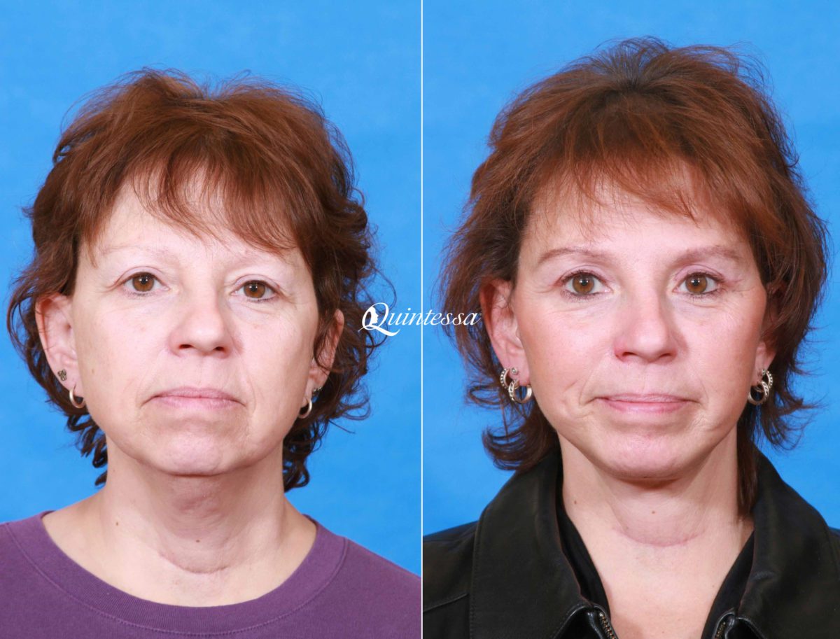 Facelift Before and After Photos in , , Patient 19918