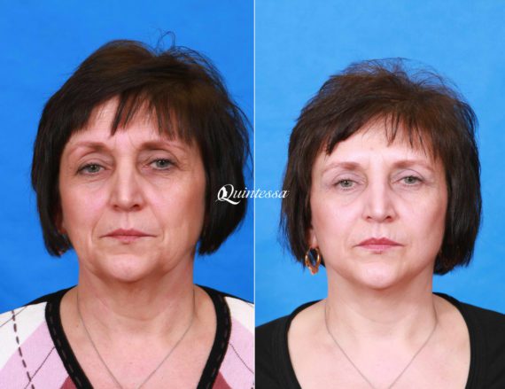 Facelift Before and After Photos in , , Patient 19924