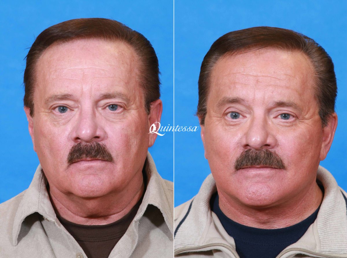 Facelift Before and After Photos in , , Patient 19928