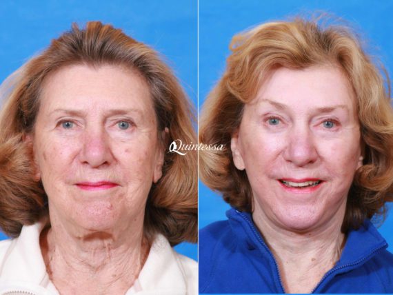 Facelift Before and After Photos in , , Patient 19932