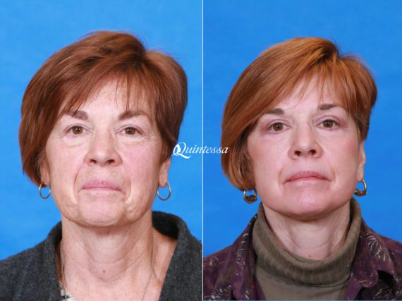 Facelift Before and After Photos in , , Patient 19936