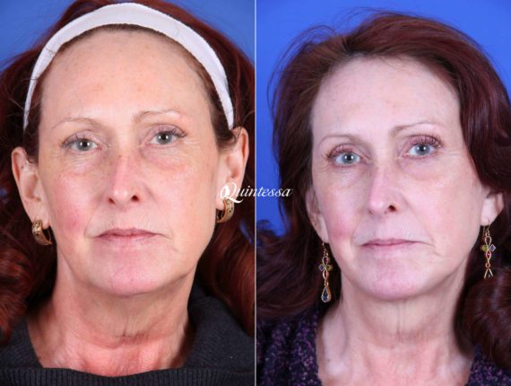 Facial Liposuction Before and After Photos in , , Patient 19940