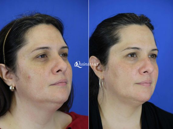 Facial Liposuction Before and After Photos in , , Patient 19954