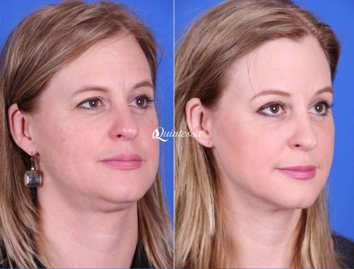 Facial Liposuction Before and After Photos in , , Patient 19956
