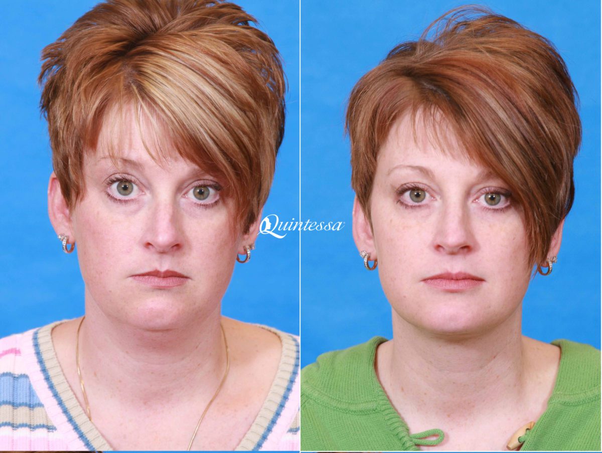 Facial Liposuction Before and After Photos in , , Patient 19958