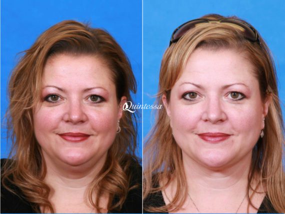 Facial Liposuction Before and After Photos in , , Patient 19960