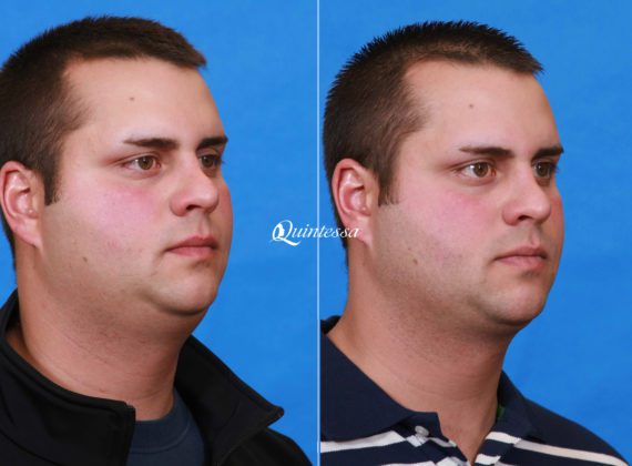 Facial Liposuction Before and After Photos in , , Patient 19962