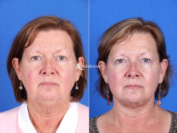 Mini Facelift Before and After Photos in , , Patient 19964