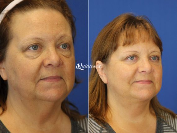 Mini Facelift Before and After Photos in , , Patient 19968