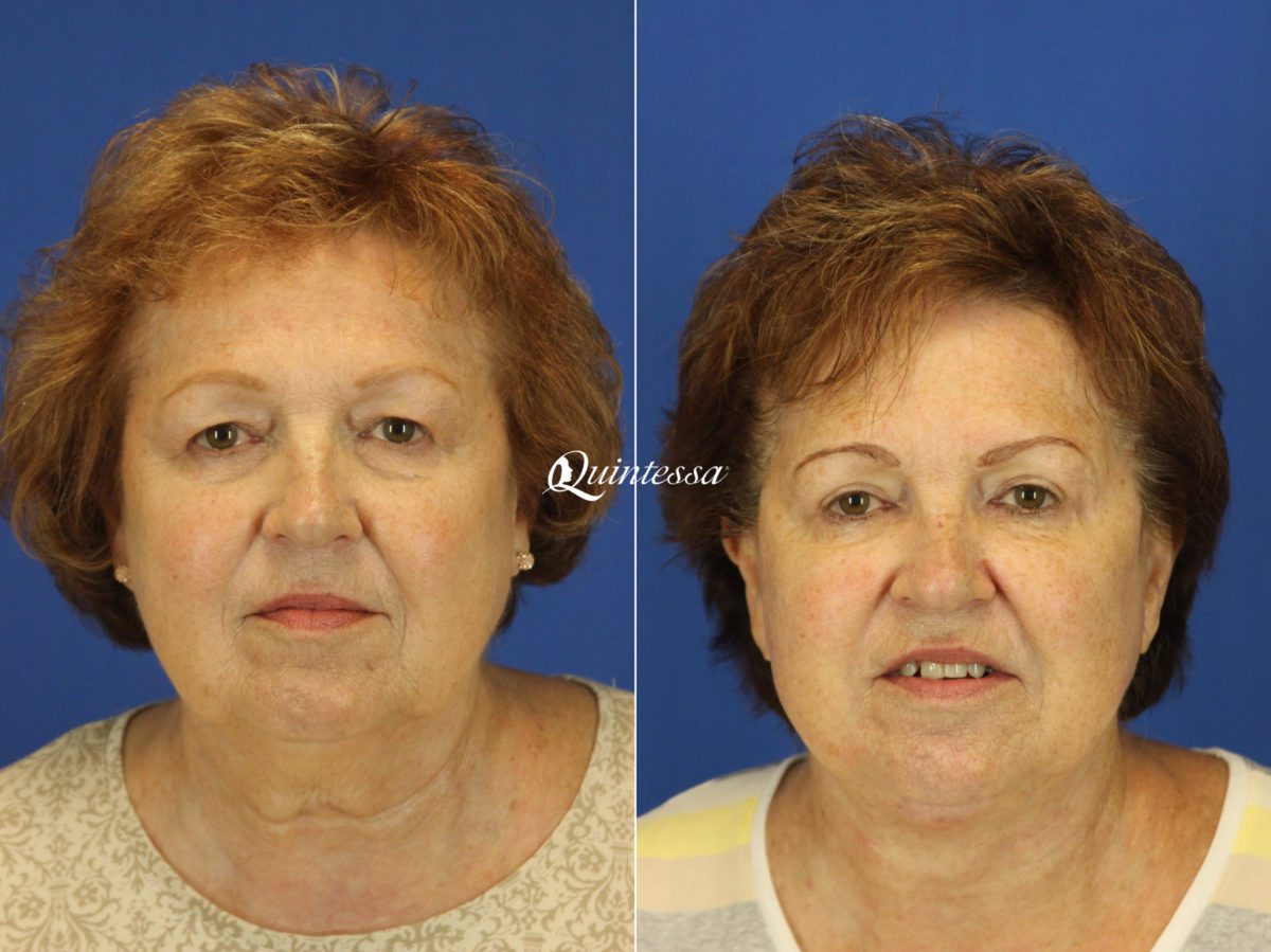 Mini Facelift Before and After Photos in , , Patient 19972