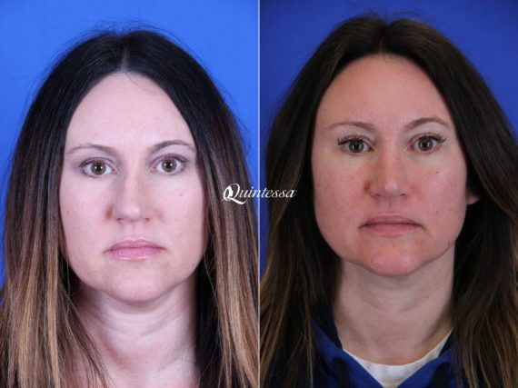 Rhinoplasty Before and After Photos in , , Patient 19976