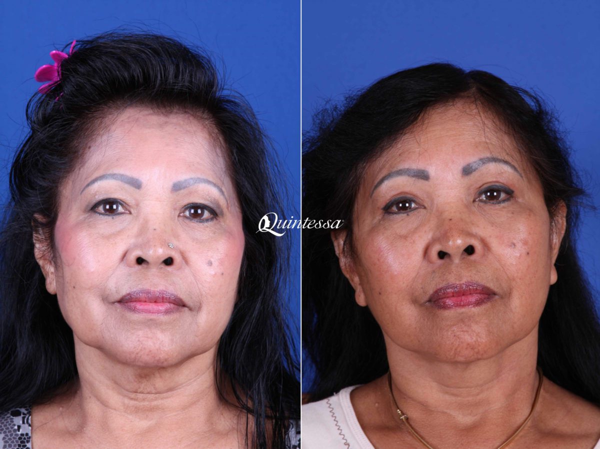 Mini Facelift Before and After Photos in , , Patient 19980