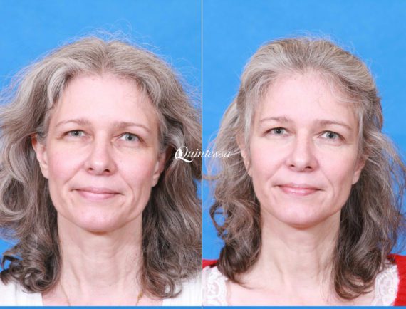 Mini Facelift Before and After Photos in , , Patient 19994