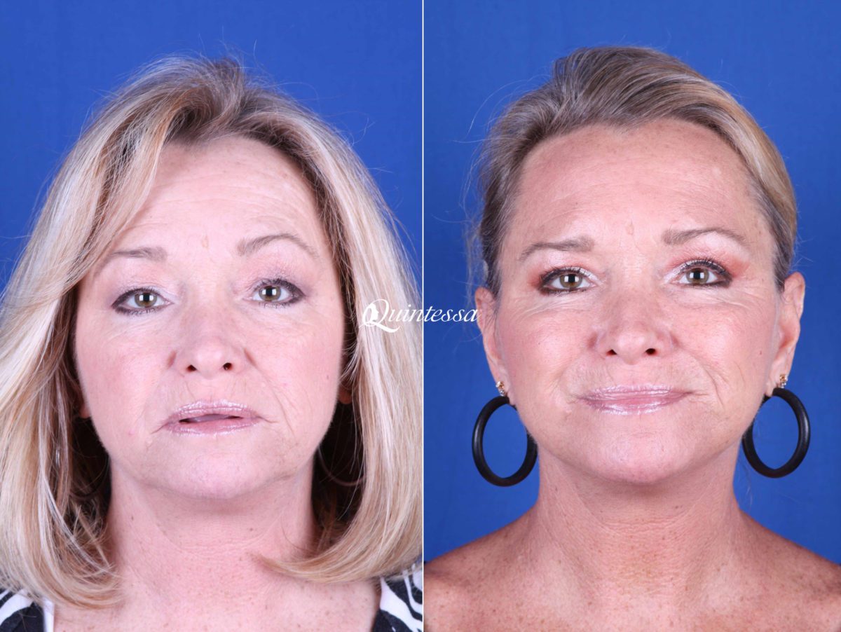 Mini Facelift Before and After Photos in , , Patient 19998