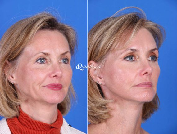 Mini Facelift Before and After Photos in , , Patient 20000
