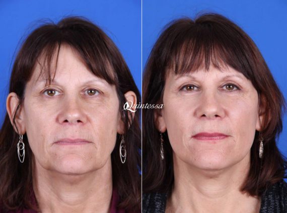 Mini Facelift Before and After Photos in , , Patient 20002