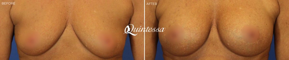 Breast Augmentation Before and After Photos in Madison, WI, Patient 20022