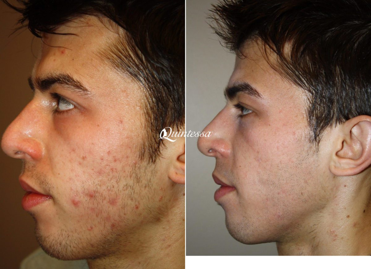 BBL Laser Facial Before and After Photos in Sheboygan, WI, Patient 20044