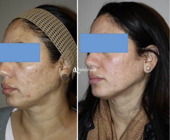 BBL Laser Facial Before and After Photos in Madison, WI, Patient 20046