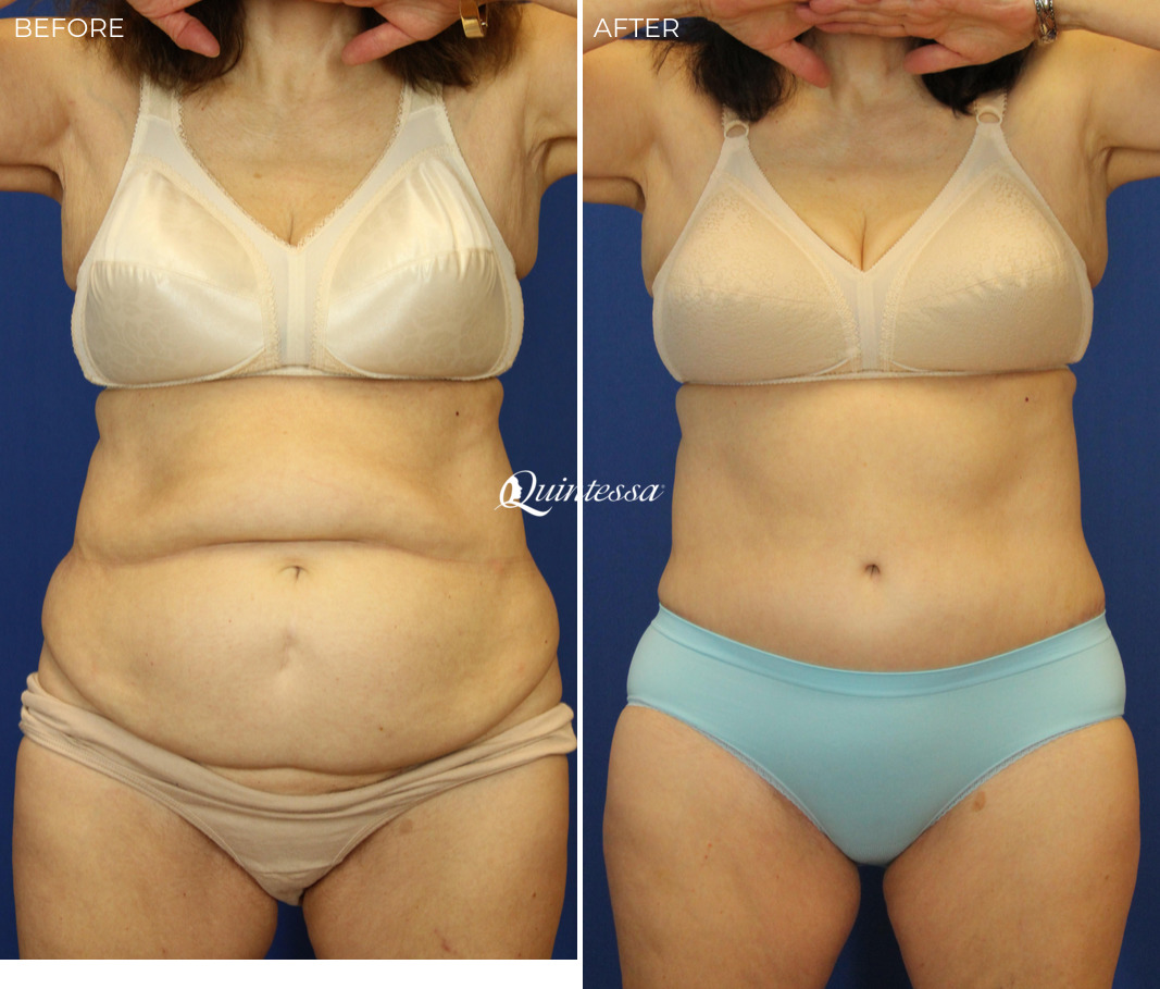 Tummy Tuck Before and After Photos in Mequon, WI, Patient 20050
