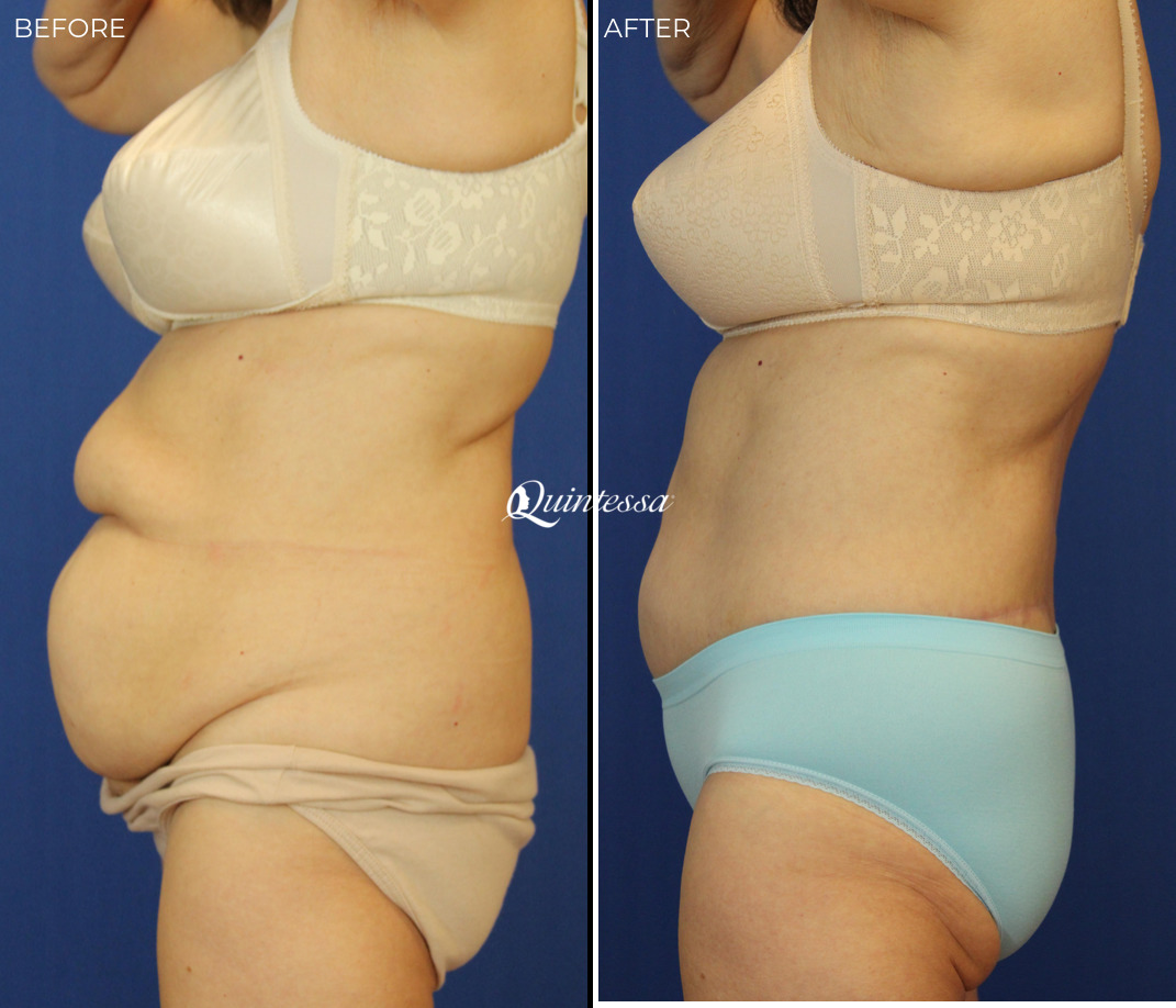 Tummy Tuck Before and After Photos in Middleton, WI, Patient 20059