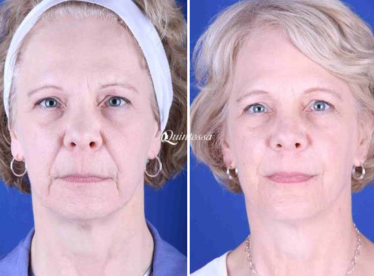 Facelift Before and After Photos in Middleton, WI, Patient 20068