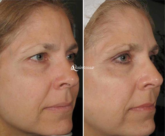 Facelift Before and After Photos in Sheboygan, WI, Patient 20072