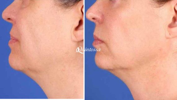 Facelift Before and After Photos in Delafield, WI, Patient 20076
