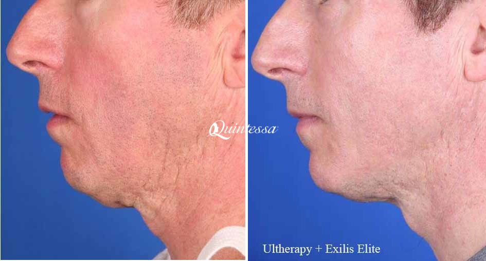 Facelift Before and After Photos in Madison, WI, Patient 20080