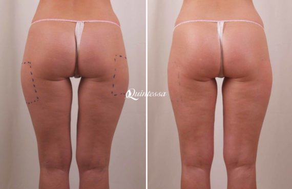 Brazilian Butt Lift Before and After Photos in Mequon, WI, Patient 20084