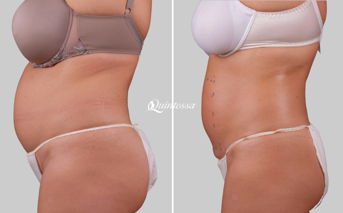 Tummy Tuck Before and After Photos in Middleton, WI, Patient 20088