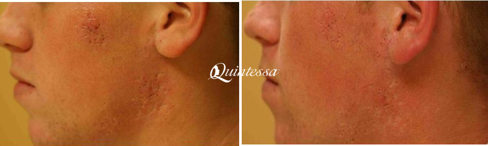BBL Laser Facial Before and After Photos in Mequon, WI, Patient 20099