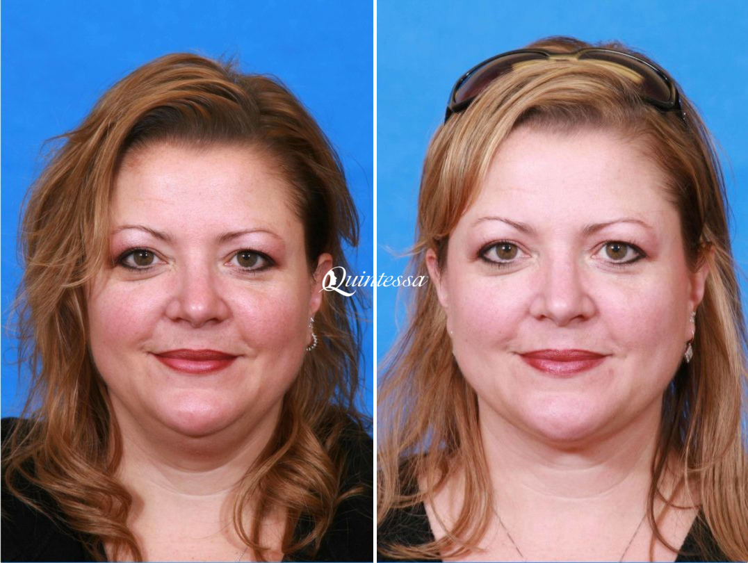 Liposuction Before and After Photos in Sheboygan, WI, Patient 20103