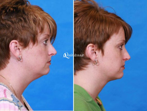 Facial Liposuction Before and After Photos in Madison, WI, Patient 20111