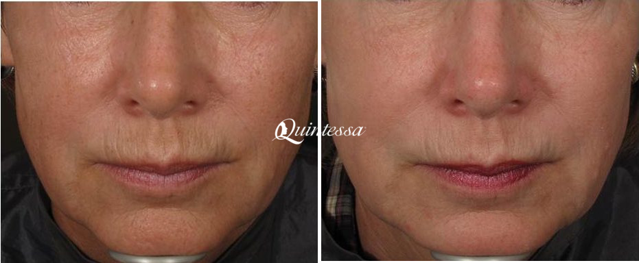 Laser Skin Resurfacing Before and After Photos in Mequon, WI, Patient 20115