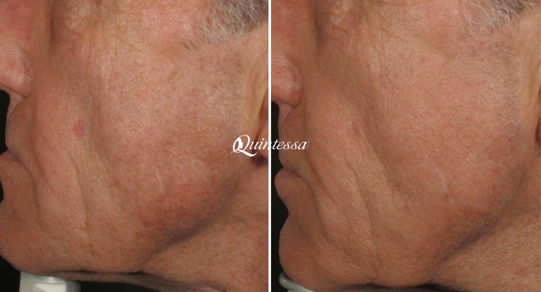 Laser Skin Resurfacing Before and After Photos in Middleton, WI, Patient 20123