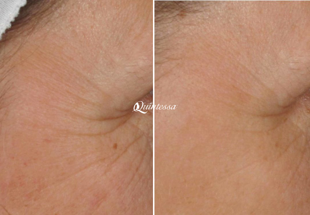 Laser Skin Resurfacing Before and After Photos in Madison, WI, Patient 20127