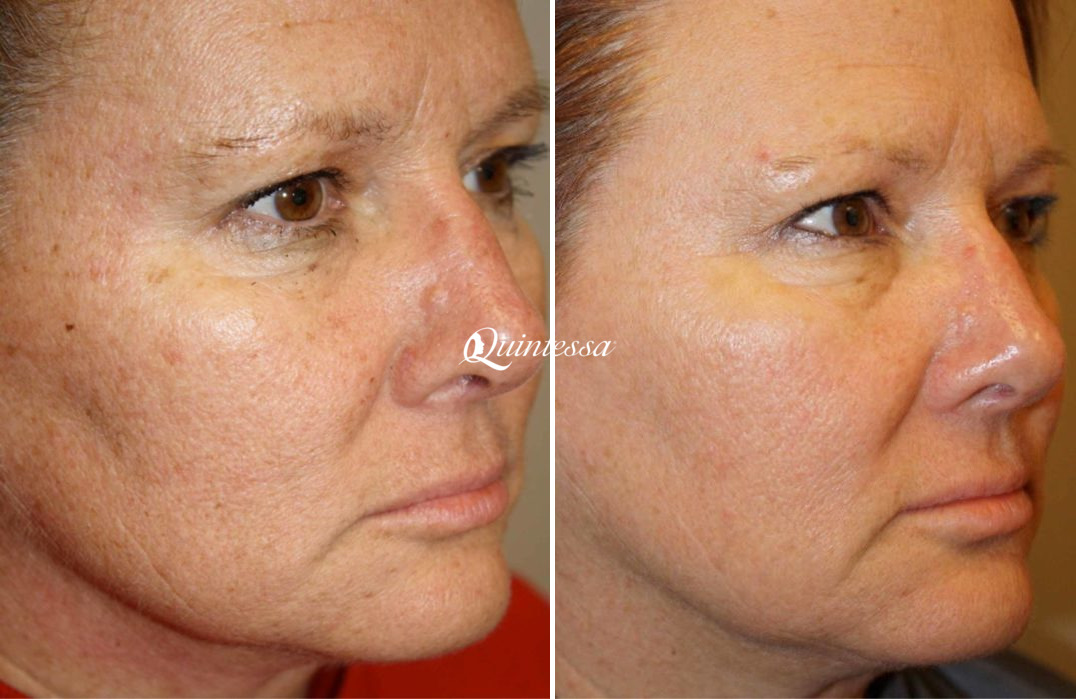Laser Skin Resurfacing Before and After Photos in Middleton, WI, Patient 20132
