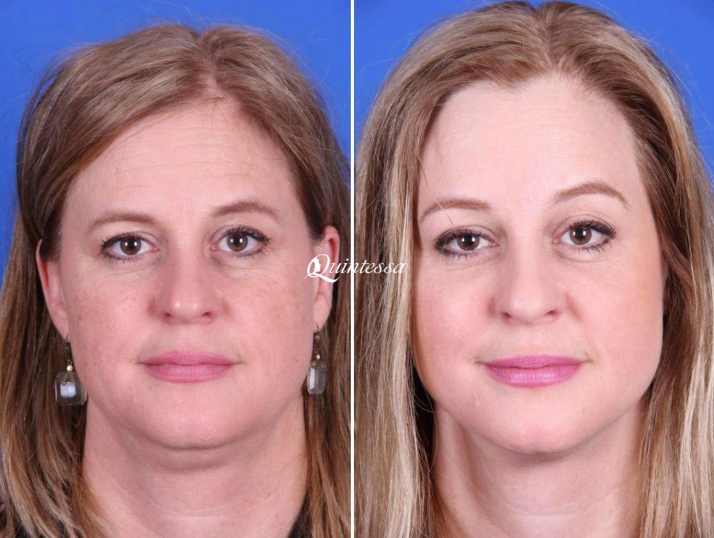 Facial Liposuction, Liposuction Photos Milwaukee Patient 20138