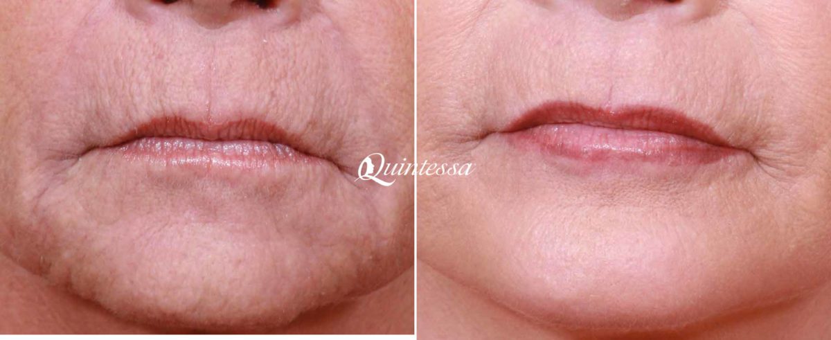 Laser Skin Resurfacing Before and After Photos in Middleton, WI, Patient 20142