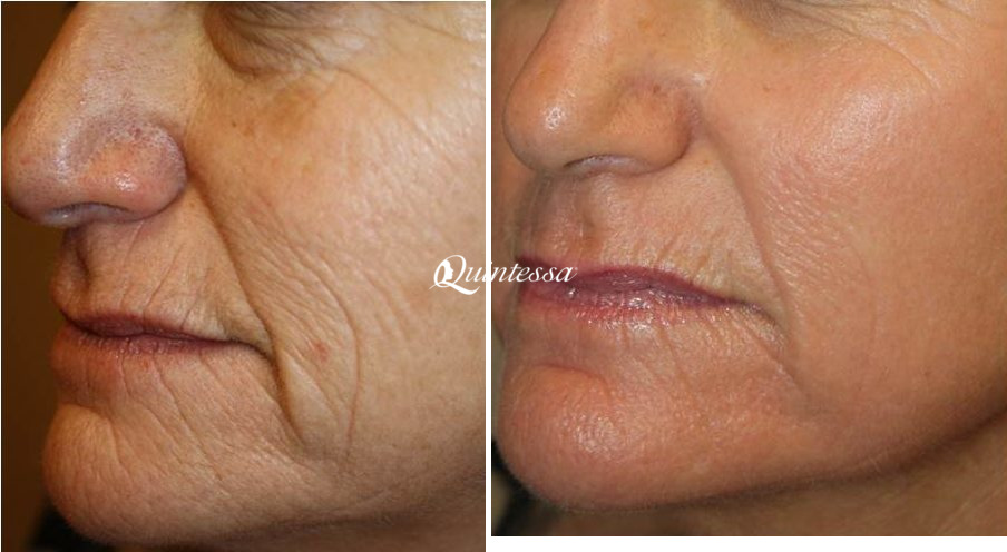 Laser Skin Resurfacing Before and After Photos in Middleton, WI, Patient 20148