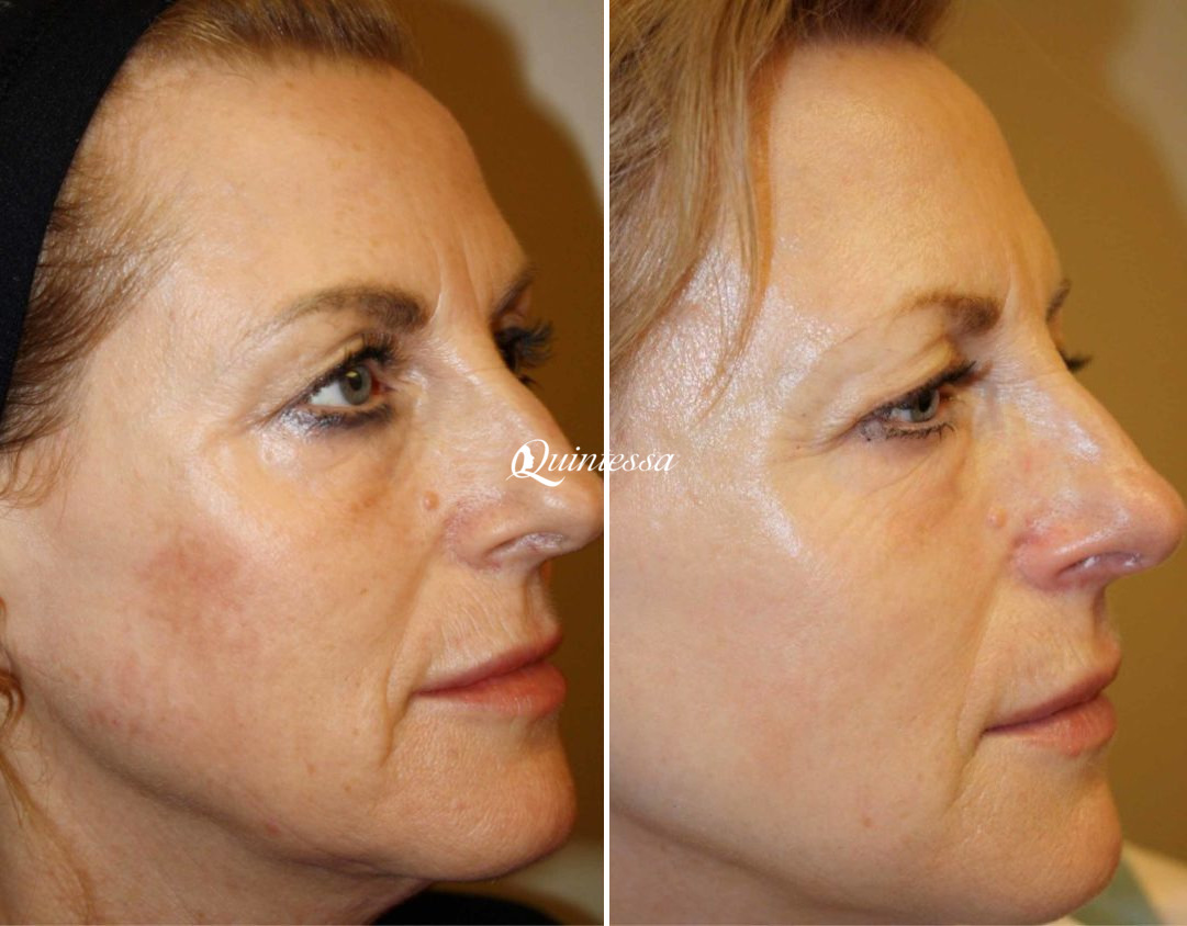 Laser Skin Resurfacing Before and After Photos in Madison, WI, Patient 20152