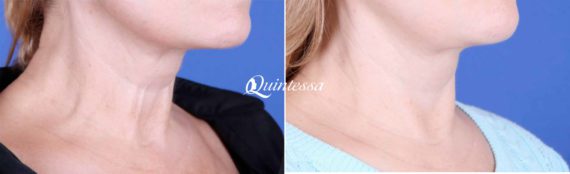 Neck Lift Before and After Photos in Sheboygan, WI, Patient 20156